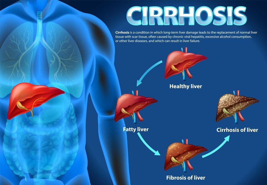 The Liver Unveiled: Causes, Symptoms, and Treatments of Liver Disease